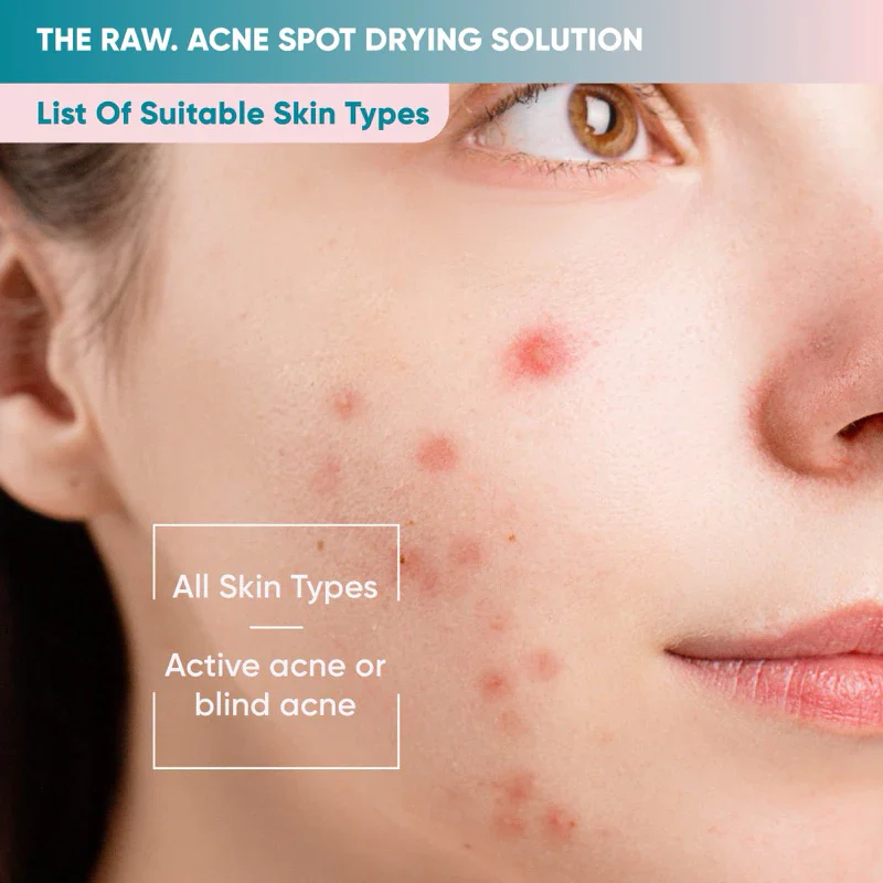 Acne Spot Drying Solution - Image 5
